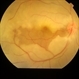 Central Artery Occlusion