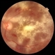 Severe Exudative Diabetic Retinopathy - Left Eye Severe Exudative Diabetic Retinopathy - Left Eye