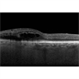 Branch Retinal Vein Occlusion Branch Retinal Vein Occlusion