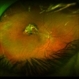 Anesthetic Needle Posterior Globe Injury