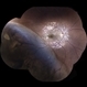 Macula ON Retinal Detachment Macula ON Retinal Detachment