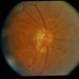 Peculiar Acute Subretinal Fibrosis Peculiar Acute Subretinal Fibrosis