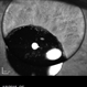 Silicone Oil Bubble in Anterior Chamber - 15 Degree Angle Silicone Oil Bubble in Anterior Chamber - 15 Degree Angle