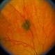 Choroidal Melanocytosis