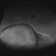 Asymptomatic Chronic Retinal Detachment With Demarcation Line Asymptomatic Chronic Retinal Detachment With Demarcation Line