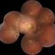 Malignant-Hypertensive-Retinopathy-2 Malignant-Hypertensive-Retinopathy-2