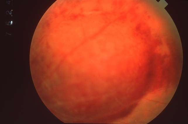 icd 10 cm code for serous choroidal detachment os