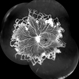 Vascular Non Perfusion in Takayasu Arteritis