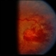 Retinal Capillary Hemangioblastoma Retinal Capillary Hemangioblastoma