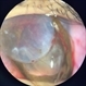 Expulsion of Retina