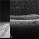 Postoperative OCT Showing Resolution of the Macular Fold Postoperative OCT Showing Resolution of the Macular Fold