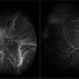 Peripheral Exudative Hemorrhagic Chorioretinopathy