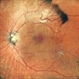 Proliferative Diabetic Retinopathy Proliferative Diabetic Retinopathy