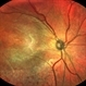 Uveitis