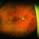Sunset Glow Fundus Sunset Glow Fundus