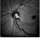 Disc Heme Wedge Defect Blue Reflectance