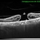 Stage 3 Macular Hole With Operculum Stage 3 Macular Hole With Operculum