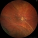 Chronic retinal detachment changes