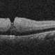 Central Retinal Artery Occlusion OCT Central Retinal Artery Occlusion OCT