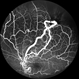 From Artery to Vein, No Detour: Meet the AV Maverick: Racemose Hemangioma From Artery to Vein, No Detour: Meet the AV Maverick: Racemose Hemangioma
