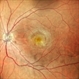 Subretinal Neovascular Membrane