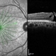 Radial Scan Macular Hole Radial Scan Macular Hole