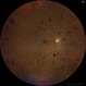 Leukemic Retinopathy Leukemic Retinopathy