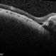 Tilted Disc Syndrome Complicated with RPE Atrophy and Polypoidal Choroidal Vasculopathy Tilted Disc Syndrome Complicated with RPE Atrophy and Polypoidal Choroidal Vasculopathy