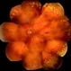 Gyrus Dystrophy