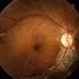 Pigmented Paravenous Retinochoroidal Atrophy Pigmented Paravenous Retinochoroidal Atrophy