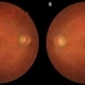 Lipemia Retinalis: Key to Diagnose a Systemic Disease