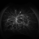 Proliferative Diabetic Retinopathy Angiography Proliferative Diabetic Retinopathy Angiography