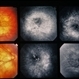 Myopia Myopia