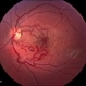 Racemose Hemangiomatosis