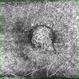 Subretinal Neovascular Membrane Subretinal Neovascular Membrane