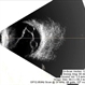 Multiple Retinal Cysts Associated With Chronic Retinal Detachment Multiple Retinal Cysts Associated With Chronic Retinal Detachment