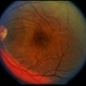 Scleritis / OIS Scleritis / OIS