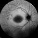 Cone-Rod Dystrophy