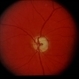 Sturge-Weber / Choroidal Hemangioma Sturge-Weber / Choroidal Hemangioma