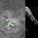 Macular Coloboma and Pigmentary Retinopathy Macular Coloboma and Pigmentary Retinopathy