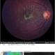 Photic Retinopathy Photic Retinopathy