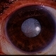 Retinal Tacks / Trauma / Silicone Oil / RD Retinal Tacks / Trauma / Silicone Oil / RD