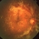 Lipemic Retina Lipemic Retina
