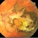 Persistent Placoid Maculopathy (PPM) Persistent Placoid Maculopathy (PPM)