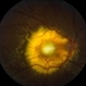 Coats' Disease - Stage 3A