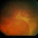 Idiopathic Pre-Retinal Membrane / Vitritis Idiopathic Pre-Retinal Membrane / Vitritis