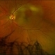 HTN Retinopathy with Pre-Papillary Vascular Loop OS HTN Retinopathy with Pre-Papillary Vascular Loop OS