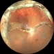 Wide Field Fundus Image of Buckle Intrusion Wide Field Fundus Image of Buckle Intrusion