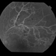BRVO With Non-perfusion