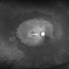 Choroidal Osteoma Choroidal Osteoma